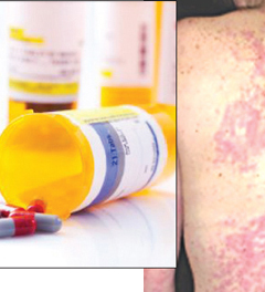 Cảnh báo phản ứng phụ nghiêm trọng của thuốc chứa paracetamol trên da
